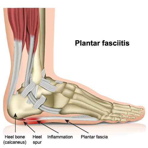 Heel Pain Plantar Faciitis